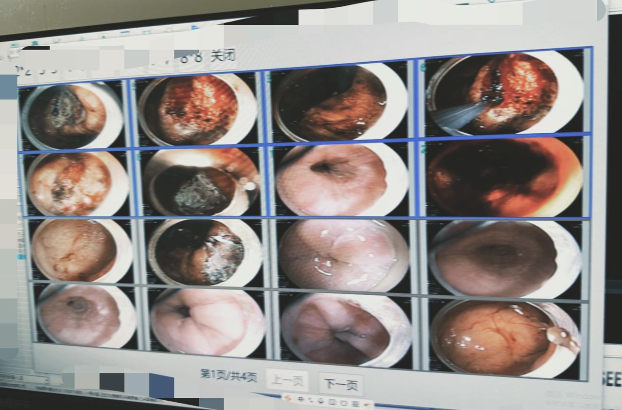 天气转凉，消化道溃疡，包括胃溃疡，十二指肠溃疡病人又明显的增多。胃溃疡严重就会出