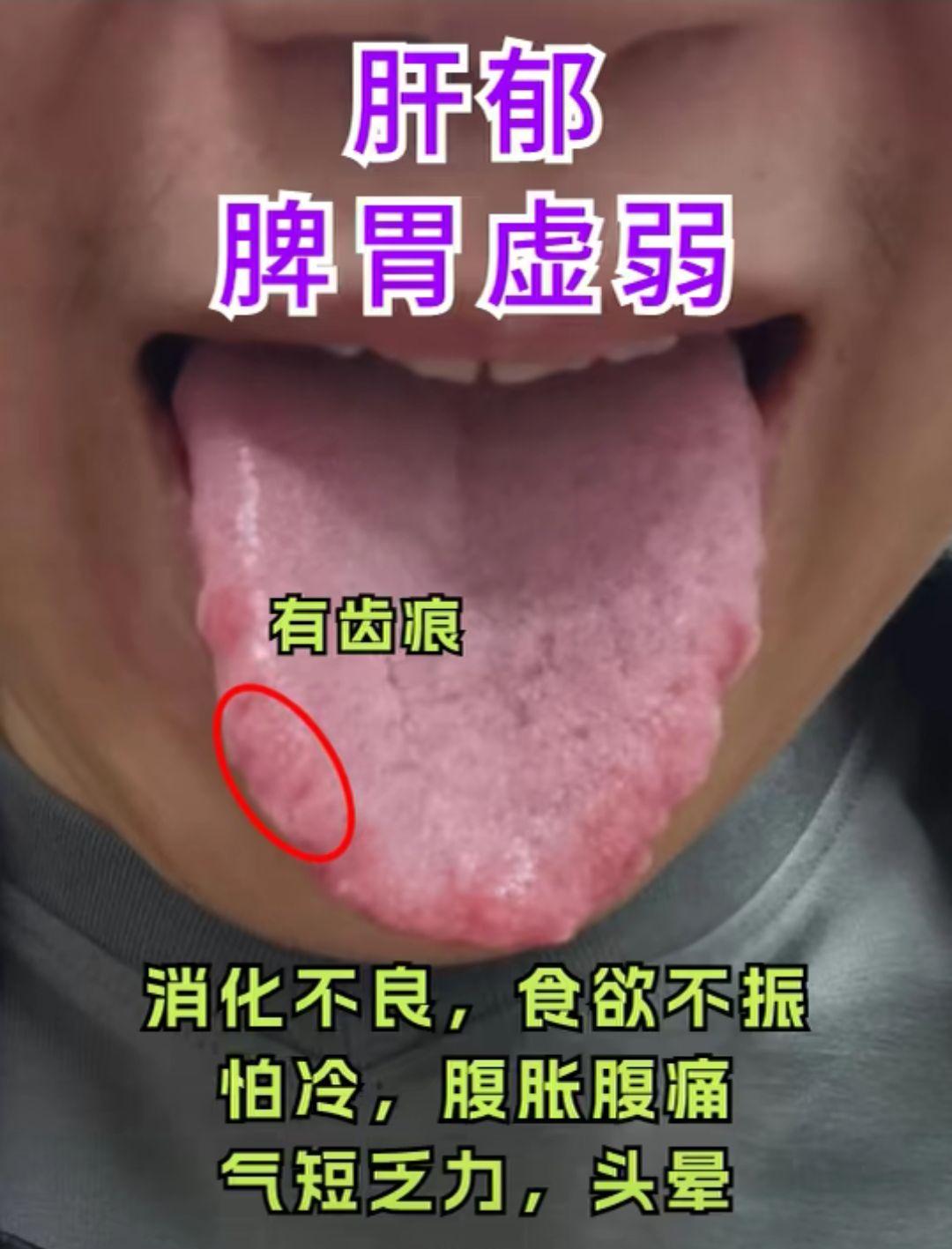 脾虚 肝郁 肺气虚 舌象分析