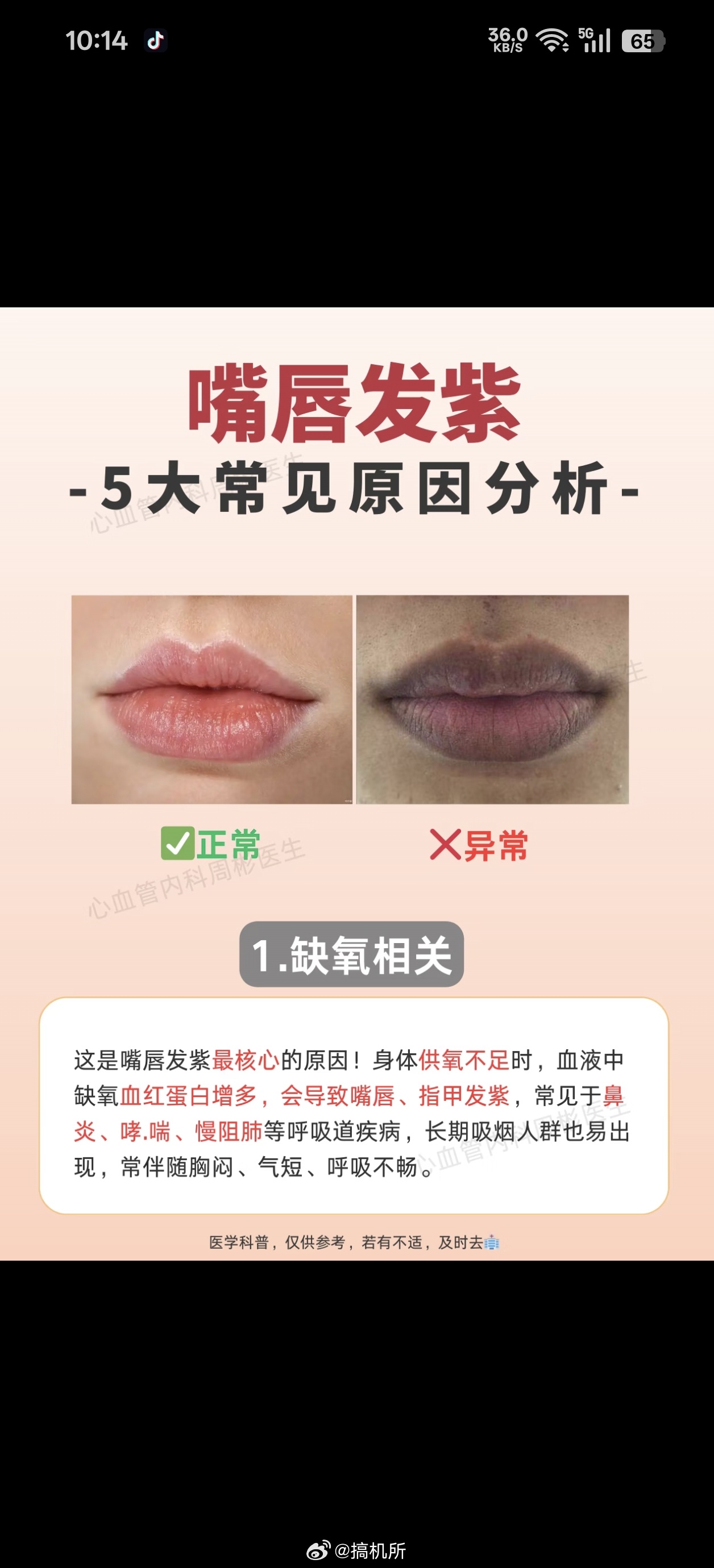 嘴唇发紫 心脏不好嘴唇发紫的原因有很多，比如嘴唇干燥、天气寒冷等，但如果长期发紫