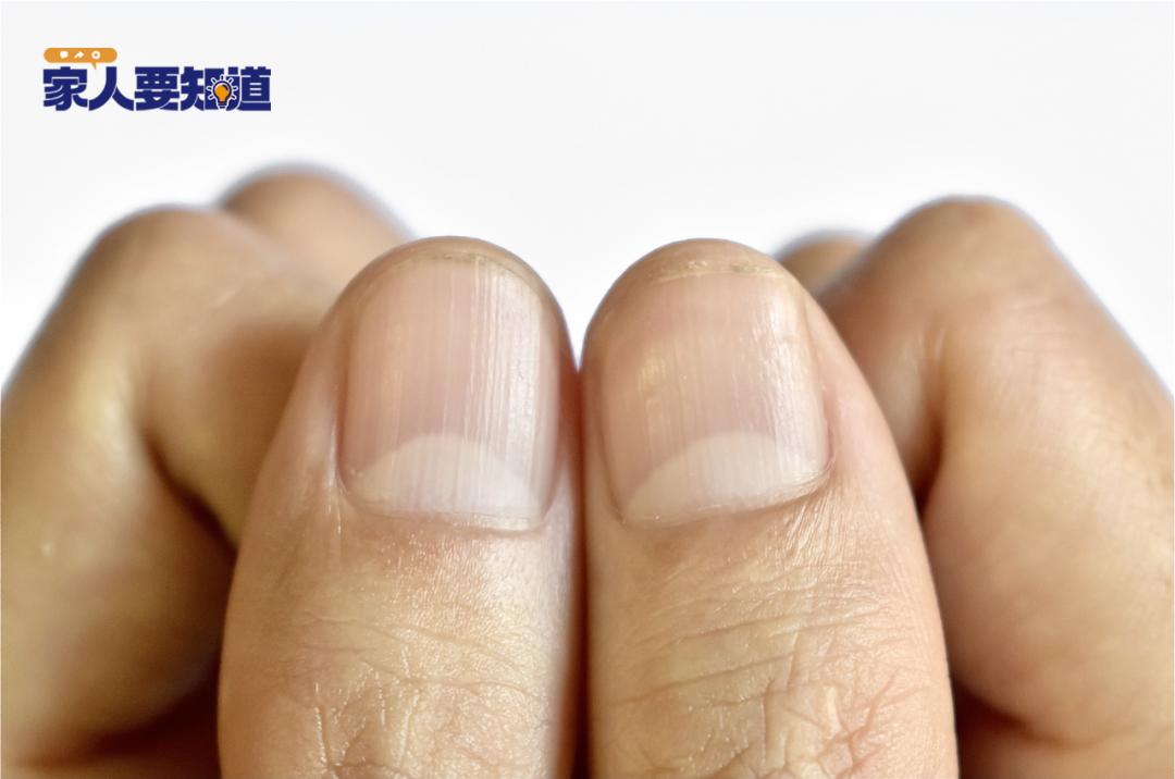 指甲起竖纹是肠胃不好？指甲“月牙”越多越健康？真相来了