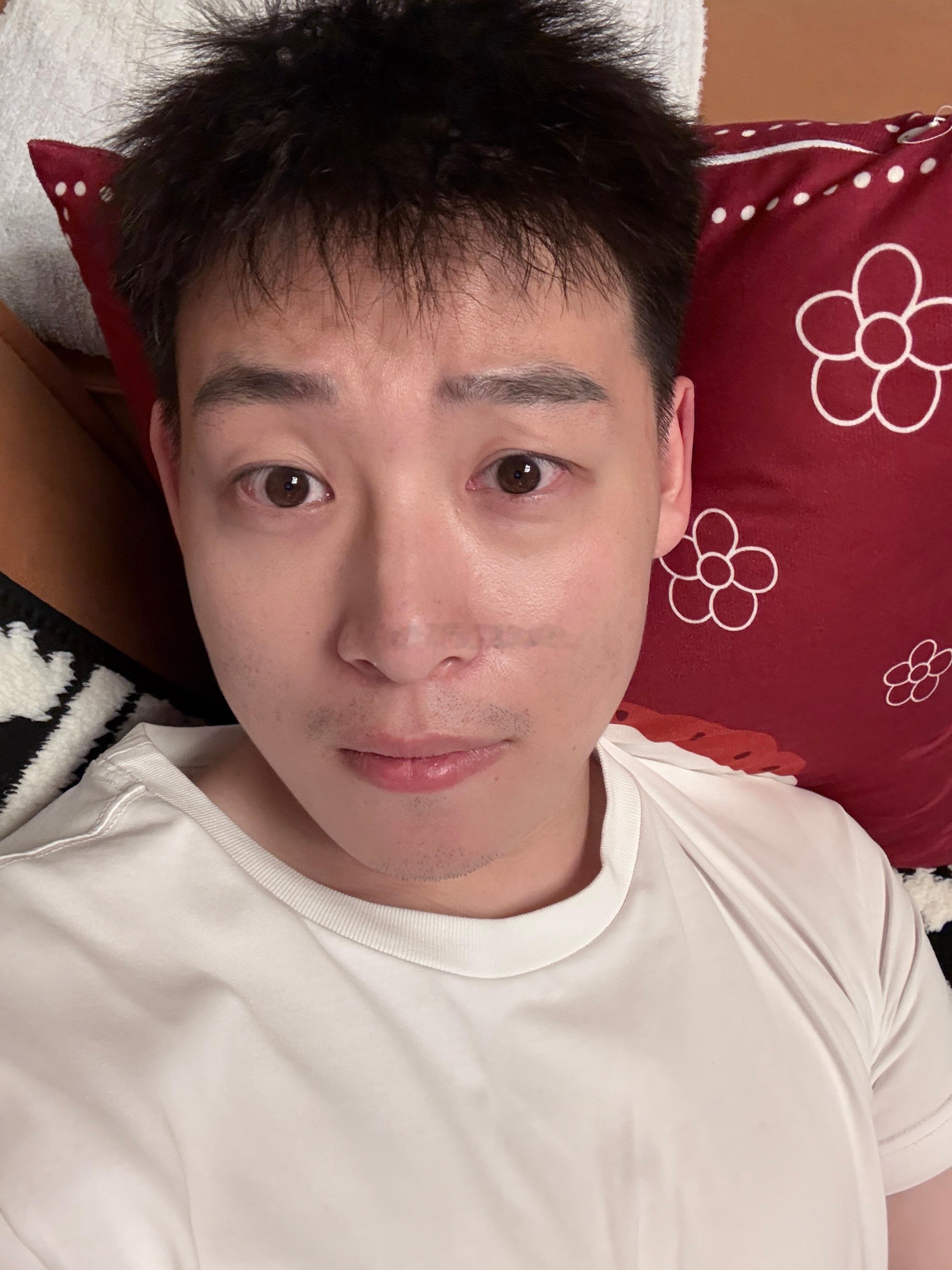 开始爆痘了，哈哈哈 