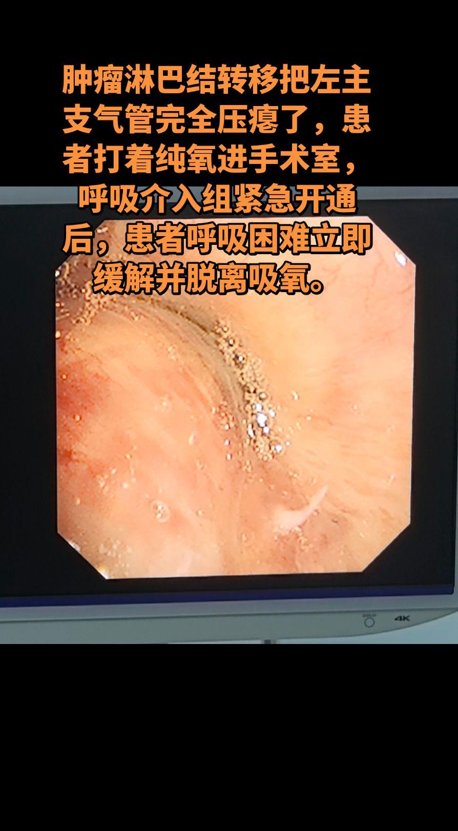 呼吸介入紧急打通主气道。