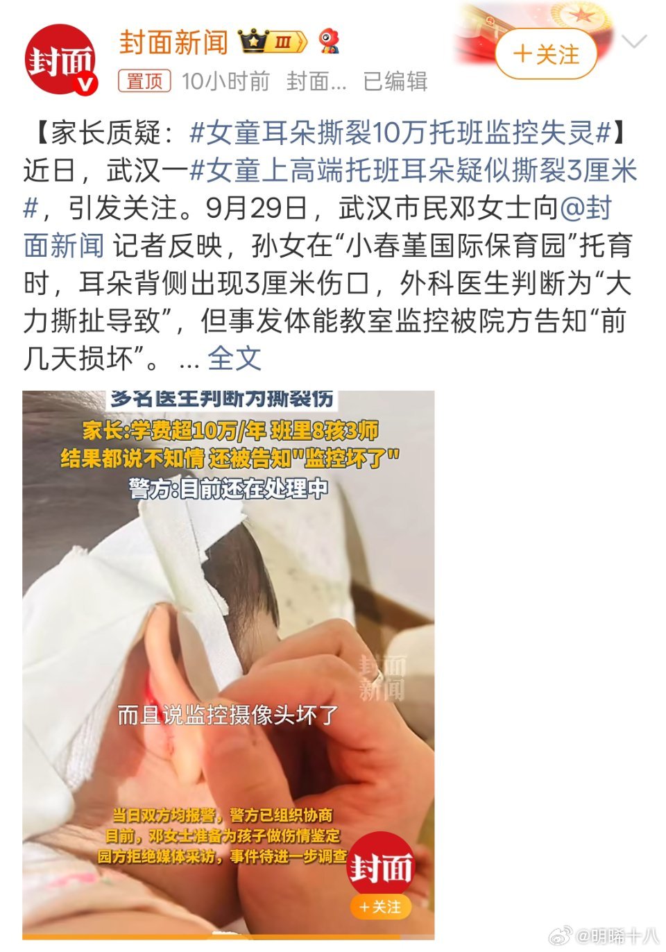 女童耳朵撕裂10万托班监控失灵女童耳朵撕裂发生在孩子在保育园托班期间，无论该保育