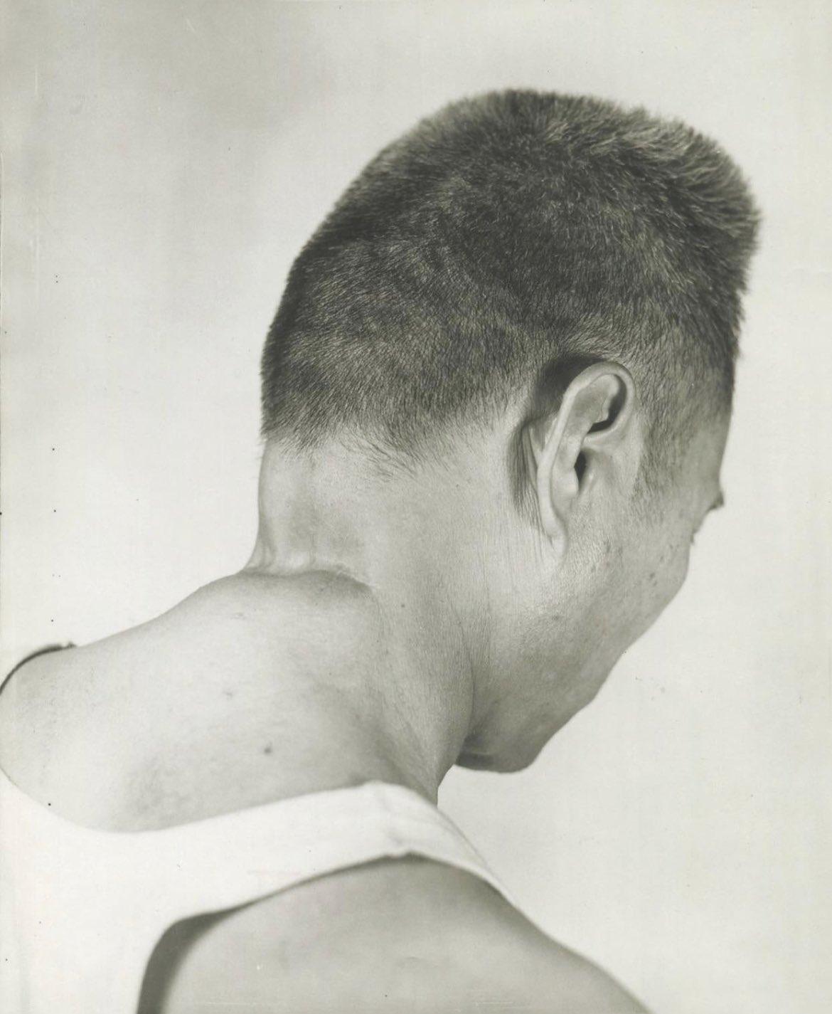 

马尼拉大屠杀中的一名菲律宾幸存者的照片，他被一名日本军官“斩首”失败，奇迹般