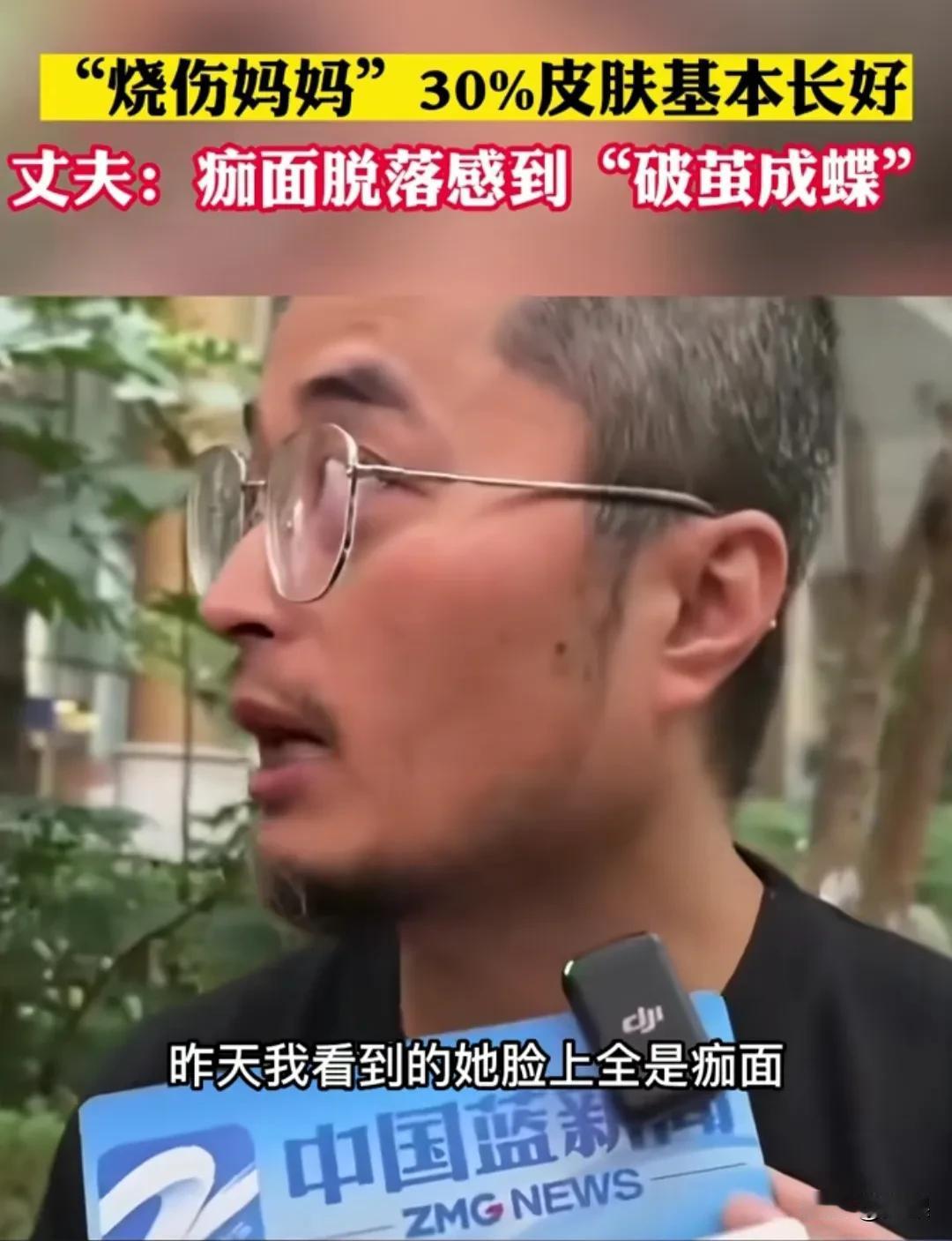 《“烧伤妈妈”皮肤基本长好：丈夫透露新进展》

近日，备受关注的“烧伤妈妈”有了
