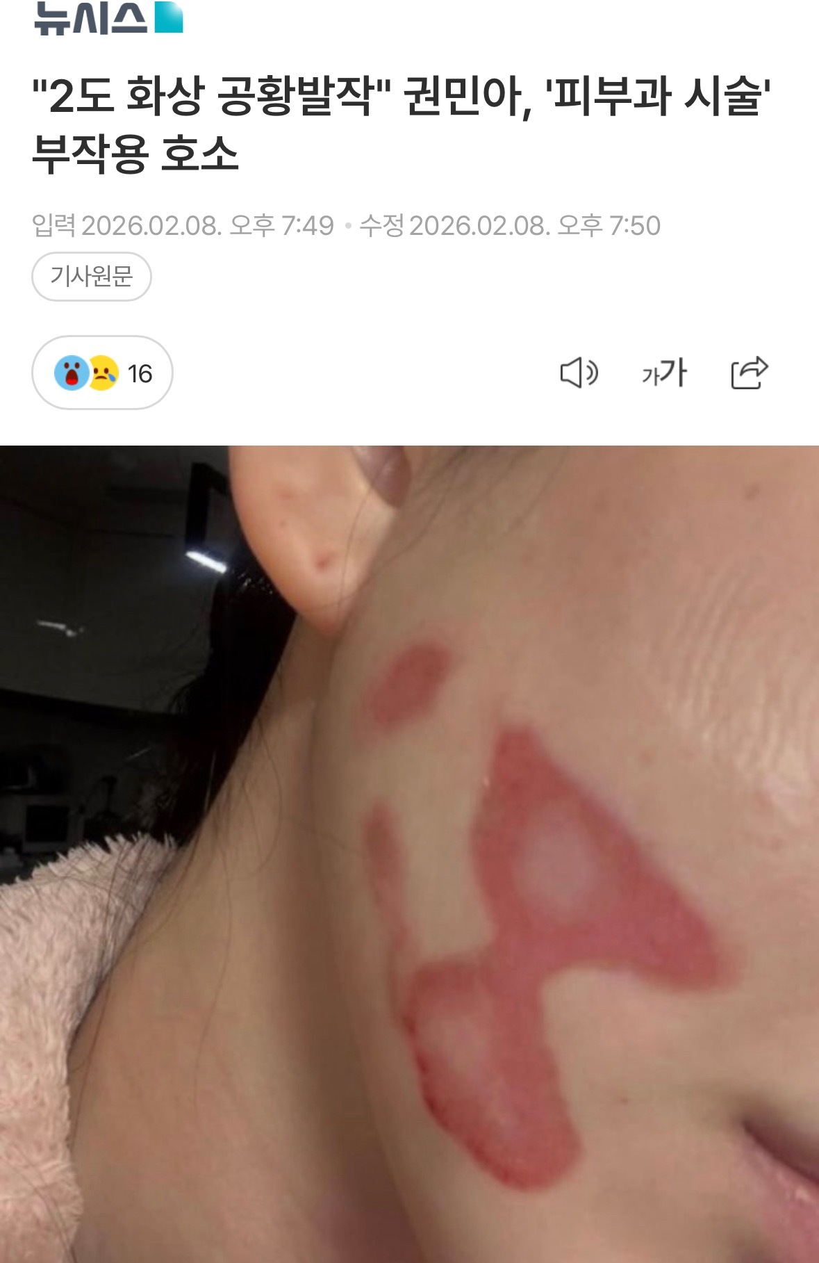 【新闻】“二度烧伤、惊恐发作” 权珉娥诉苦称遭遇医美副作用权珉娥医美后毁容权珉娥