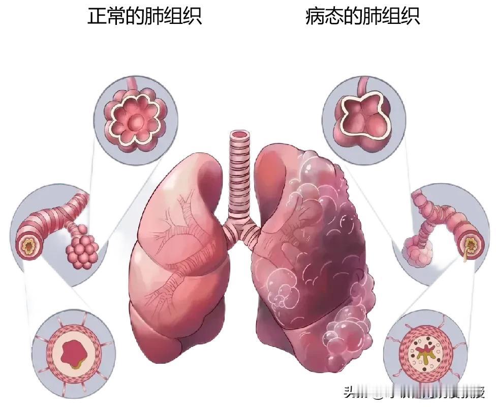 慢阻肺的全称为慢性阻塞性肺疾病，中国现在大约有一亿左右的慢阻肺患者，主要是中老年