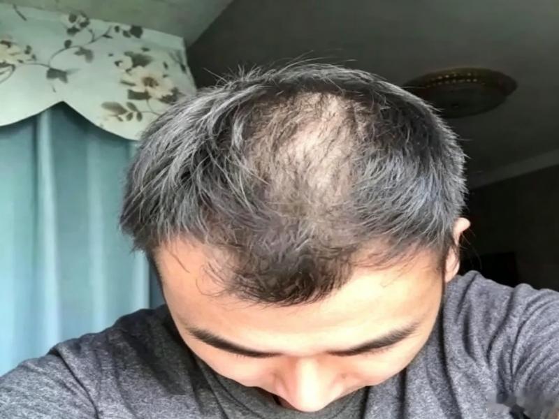 人间奇迹！
戒烟后长出黑发！
西安一男子亲身经历惊呆众人。

西安一位大哥烟龄二