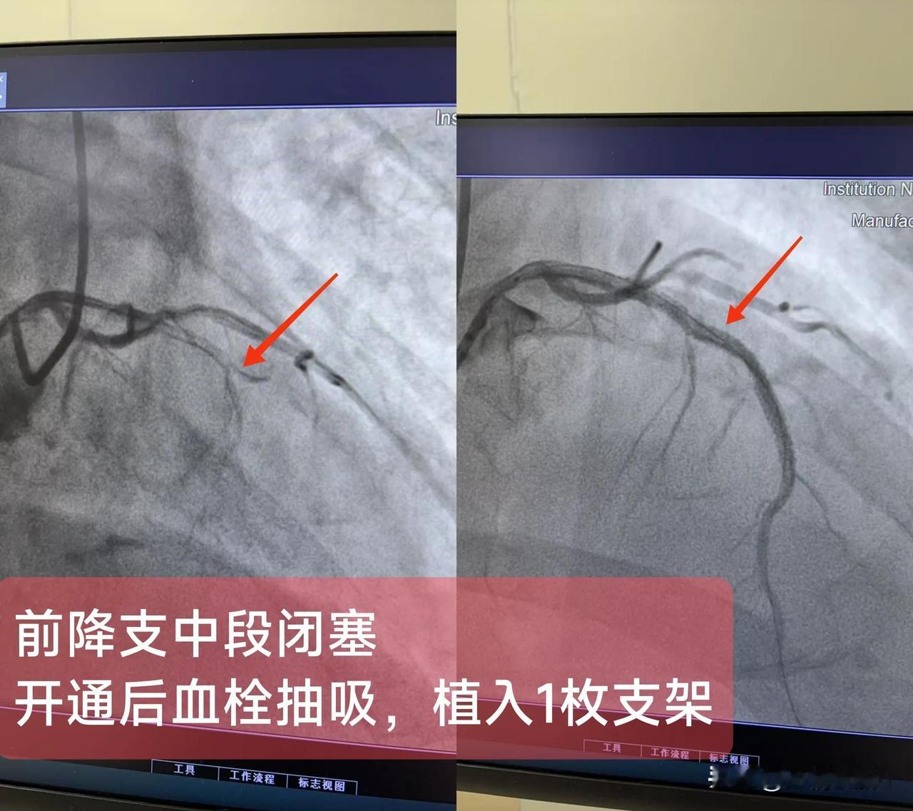 急性ST段抬高型心肌梗死
（前降支中段闭塞)

一.概念：
左前降支走行于室间沟