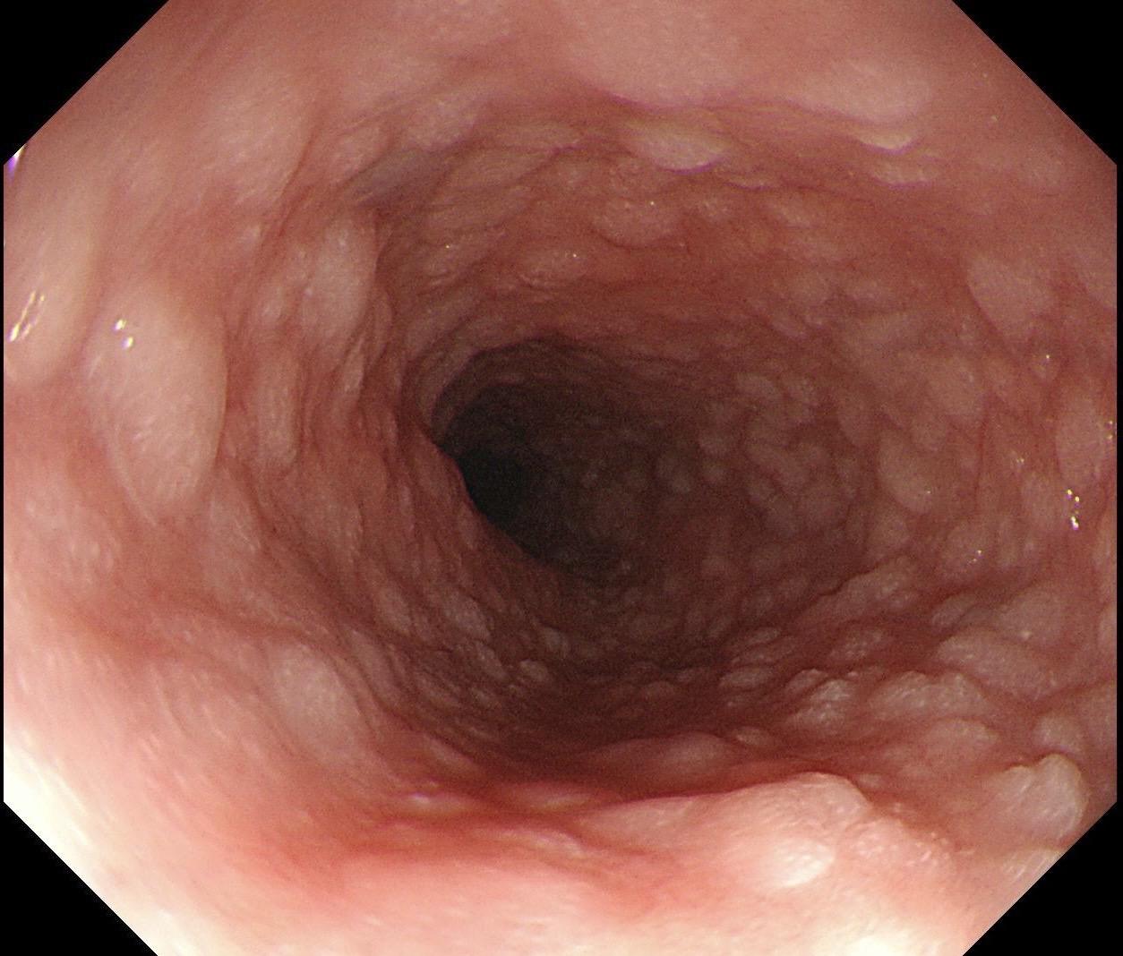 男，32岁，食管全程乳头状瘤。食管全程乳头状瘤（Esophageal ...
