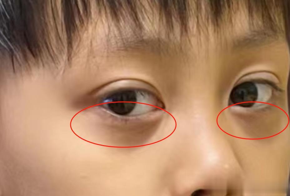 孩子顶着两个“大黑眼圈”，最可能是有这2个问题！
 
当你家孩子出现黑眼圈，这可
