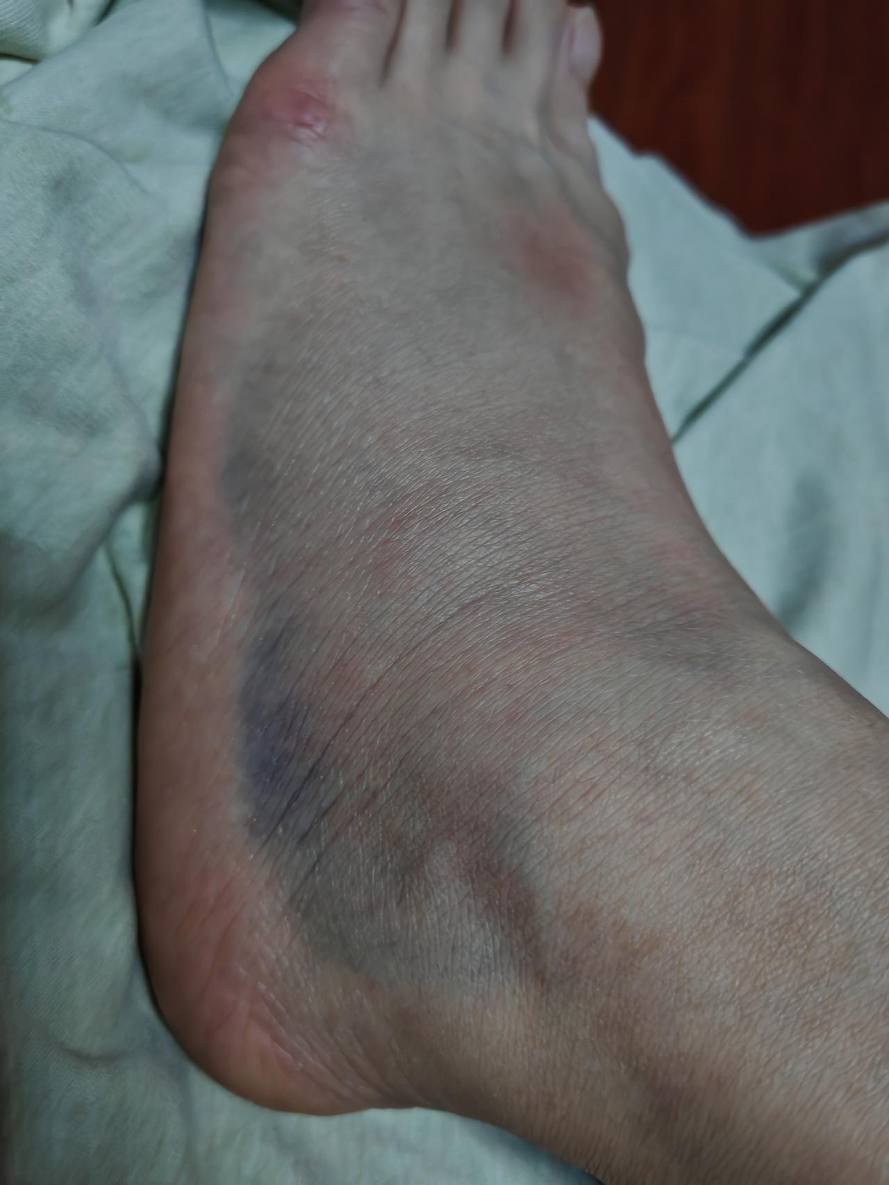 真的理解不了现在孩子的想法。
前两天我脚崴了，肿、疼得厉害，不能走路，在家休息了