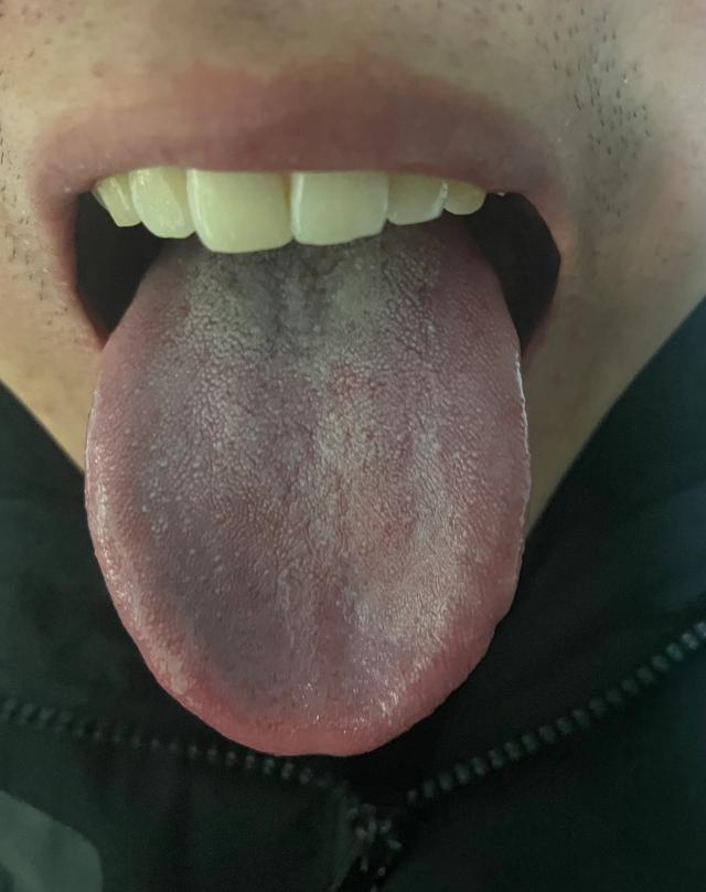 脾虚湿气重，出现这种舌苔，吃再多的参苓白术、二陈丸、归脾丸都没用！！

患者说平
