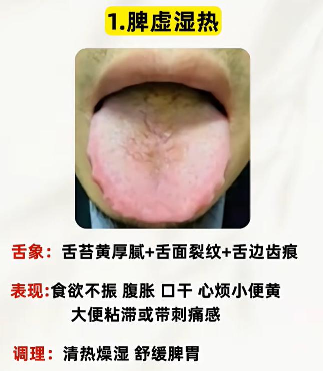 同样脾虚表现不同，从舌象区分湿热、寒湿、食积与肝郁