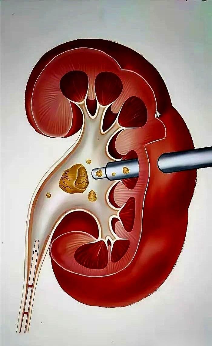 有一种手术，专治要命的肾结石。
流程就一句话：在你后腰上开个一厘米的口子，然后拿