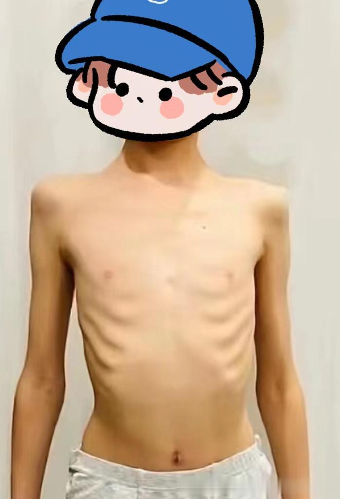 这个法子用于矮小的孩子，男女皆可！
 
前阵子，我接诊了一个小男孩，孩子6岁，身