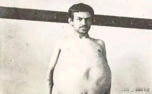 “他是被屎憋死的。”1940年，一美国男人因为三年没有排泄，最终不幸去世，医生检