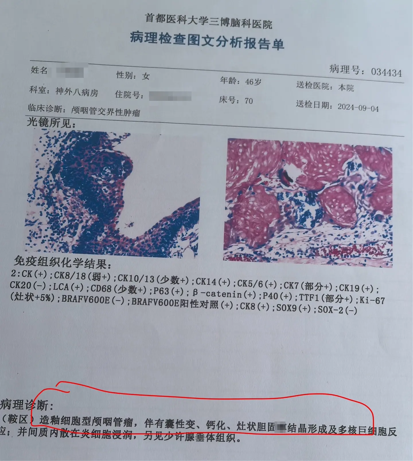 颅咽管瘤与拉克氏囊肿好鉴别吗？典型的造釉细胞型颅咽管瘤有钙化，与拉克氏...