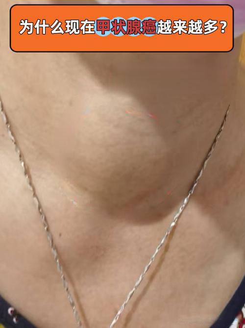 《天国的嫁衣》男主立威廉患癌！这个“懒癌”盯上46万中国人，你还不检查脖子吗？