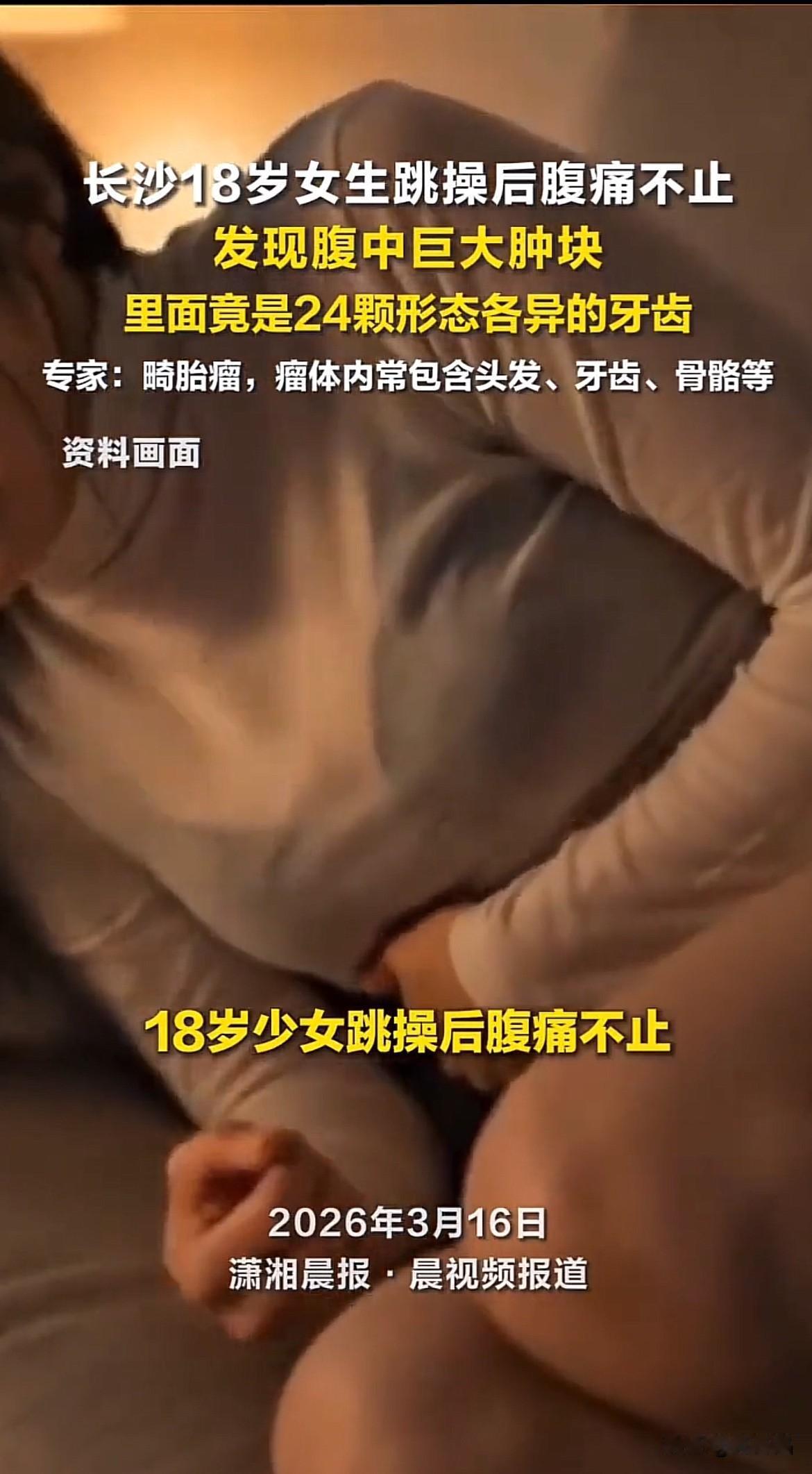 长沙18岁少女在家跳操后腹痛难忍，就医发现是畸胎瘤，手术取出12厘米肿块（有24