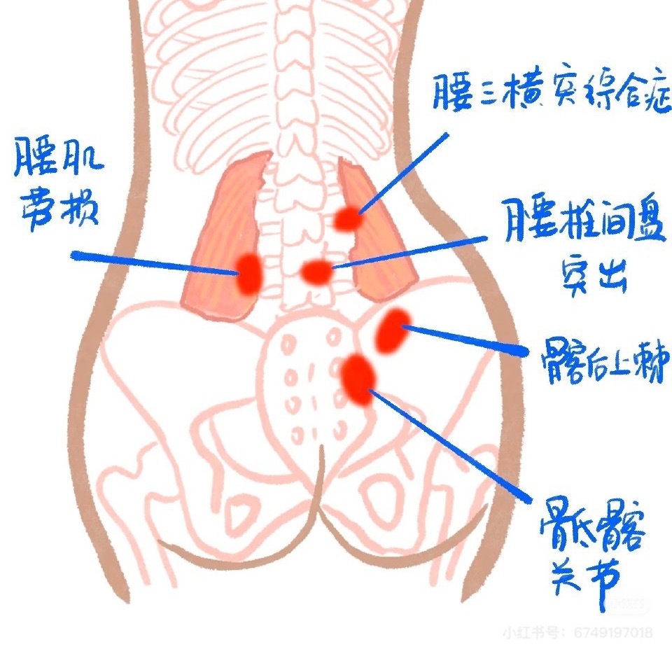腰痛 今天继续来讲腰椎，常见的损伤原因与症状——①【腰三横突综合征】——第三腰两