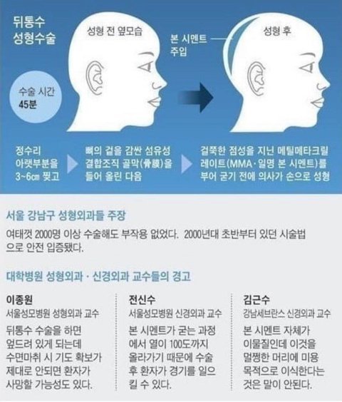 韩国还有后脑勺水泥整形[哆啦A梦害怕] ​​​