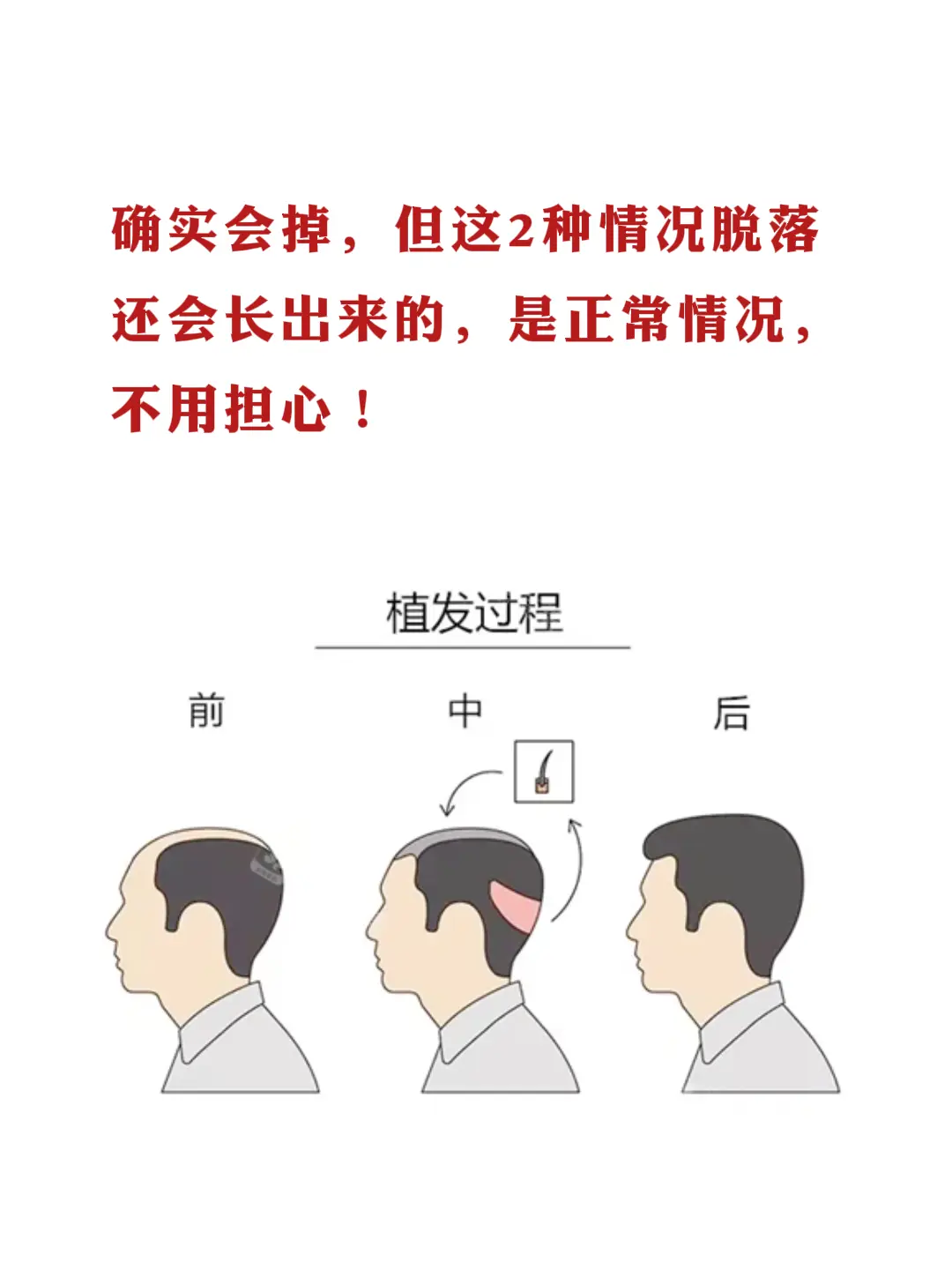 植发只能维持2-3年，这是真的吗？。确实会掉，但这2种脱落是正常情况。...