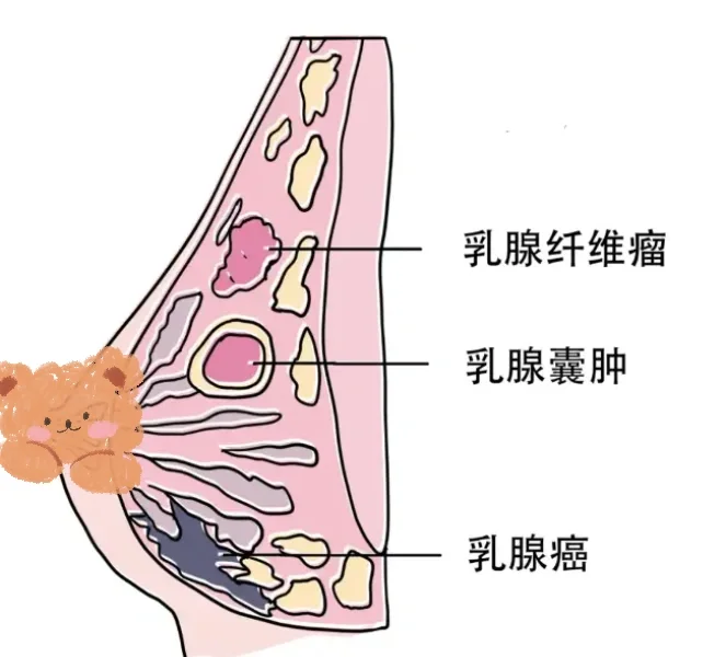 罹患乳腺癌高危人群的定义 	 存在下列情况之一者 	 (1) 有明显的...