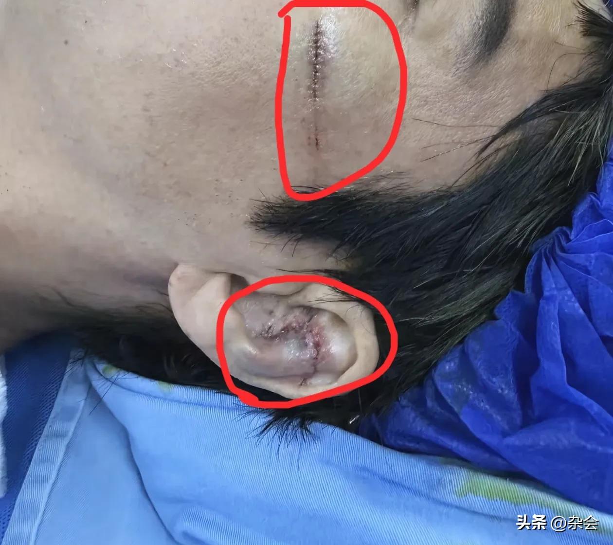 看到王力宏面部缝合的画面，真的倒吸一口凉气！脸部27针，耳朵12针，哪怕用了美容