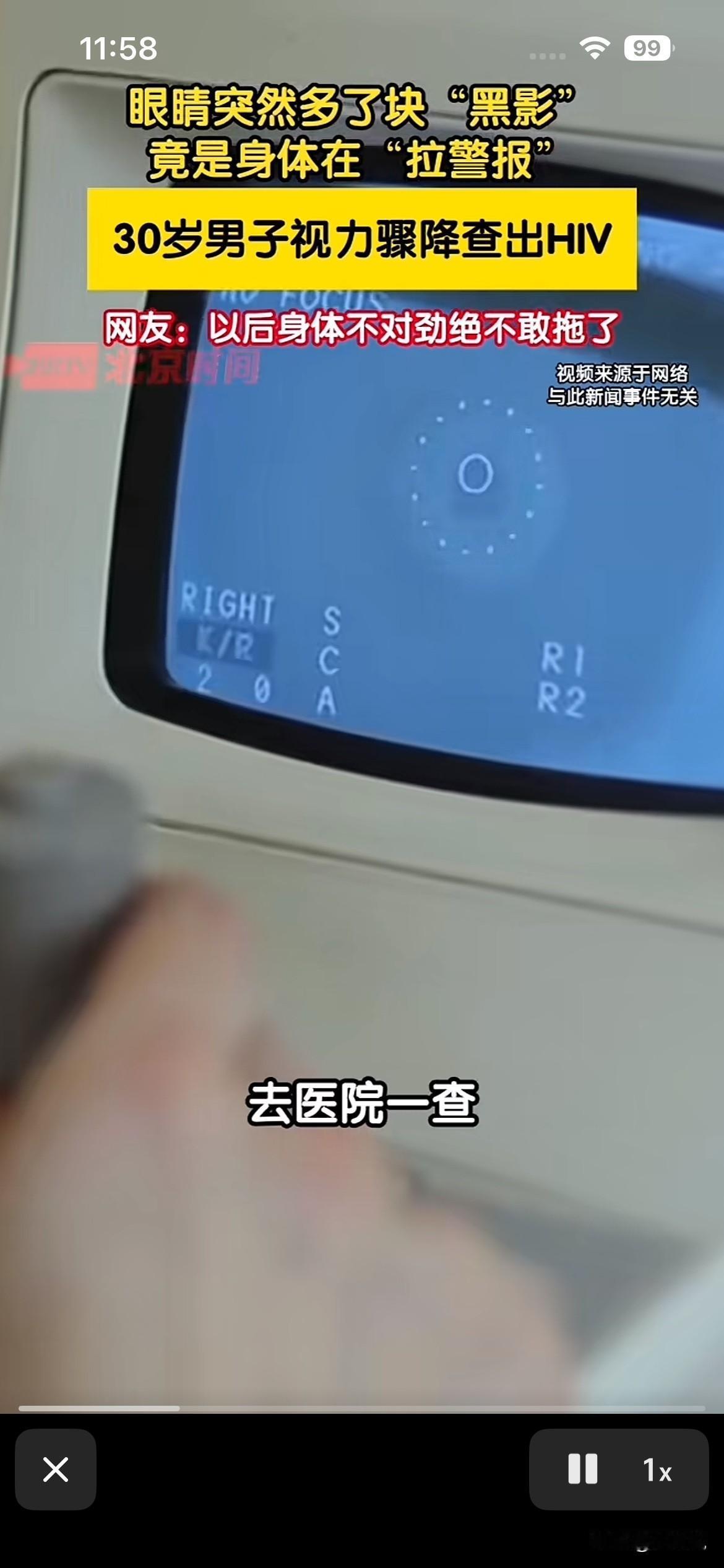 30 岁男子视力突然降低，误判为飞蚊症，右眼出现固定黑影，确诊巨细胞病毒性视网膜