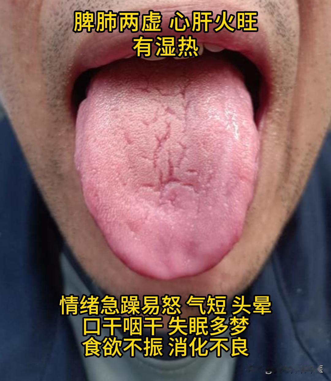 周日有时间，可以帮大家看看舌象。

有需要的，尽管把你的舌象照片发过来吧！越早发