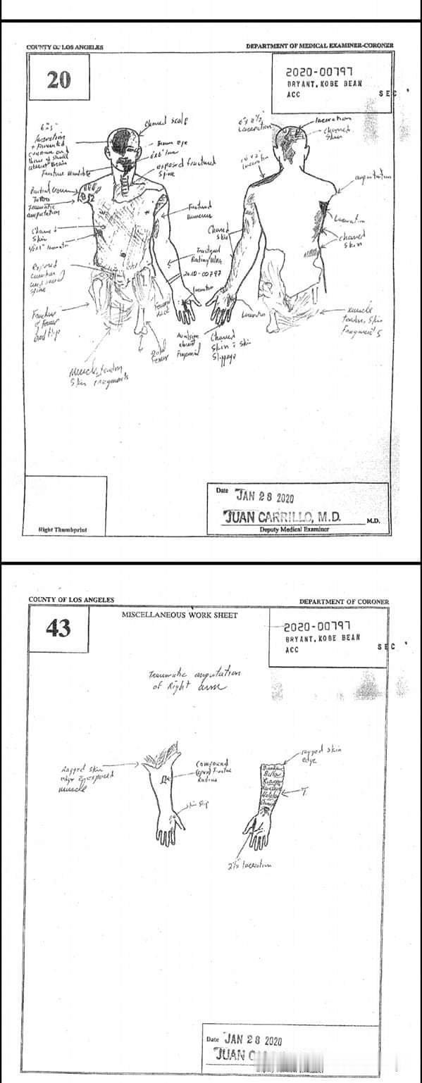 科比尸检报告。
身体几乎都被撞碎了。
科比是因为坐直升机，飞机出现事故坠落而死的