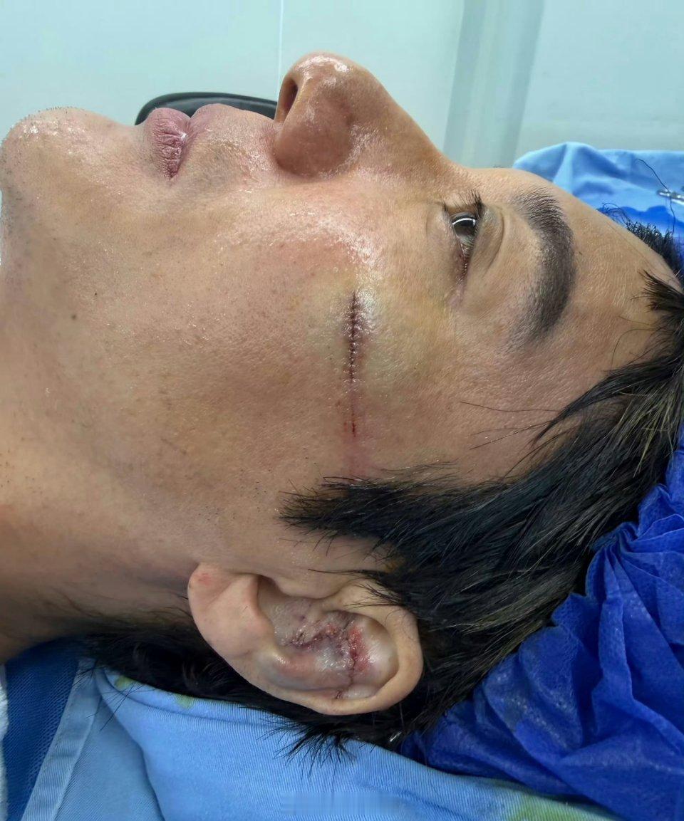 王力宏受伤的伤口 ，看起来挺严重的 