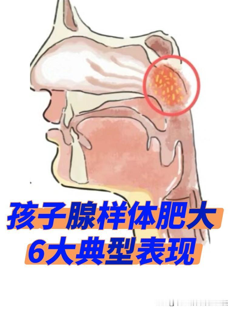 孩子出现以下6个表现，就说明有腺样体肥大的情况存在：
 
1、睡觉时打呼噜、张口