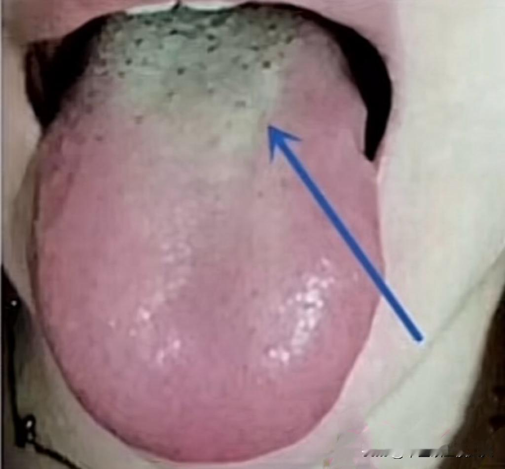 这种舌象的湿热，若清不掉，疏肝+化瘀，就事半功倍了！

这位患者舌象非常的典型，