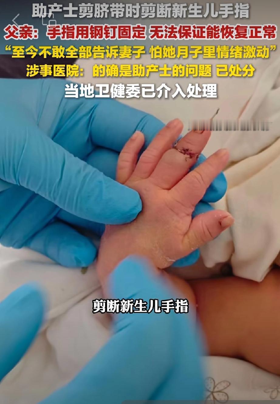 减脐带时剪断新生儿手指，1月5号孩子父亲告诉球拍新闻医院，说是因孩子的手突然乱动