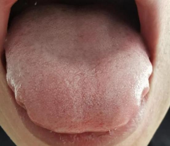 像这样的齿痕舌，真的不要再健脾了！真怕把自己的身体给搞垮！
 
舌头边像是锯齿一