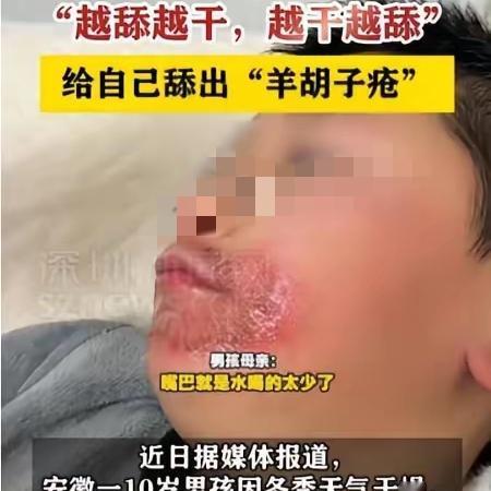 10岁男孩经常舔嘴唇
舔出“羊胡子疮”！
妈妈：孩子不爱喝水，嘴唇越干越舔，越舔