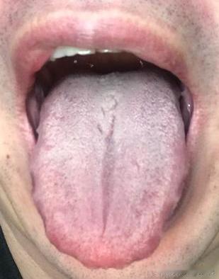 舌红苔白，多是中焦不通了？中医教你1招，健脾养胃，引火归元
这位粉丝呢年纪确实不