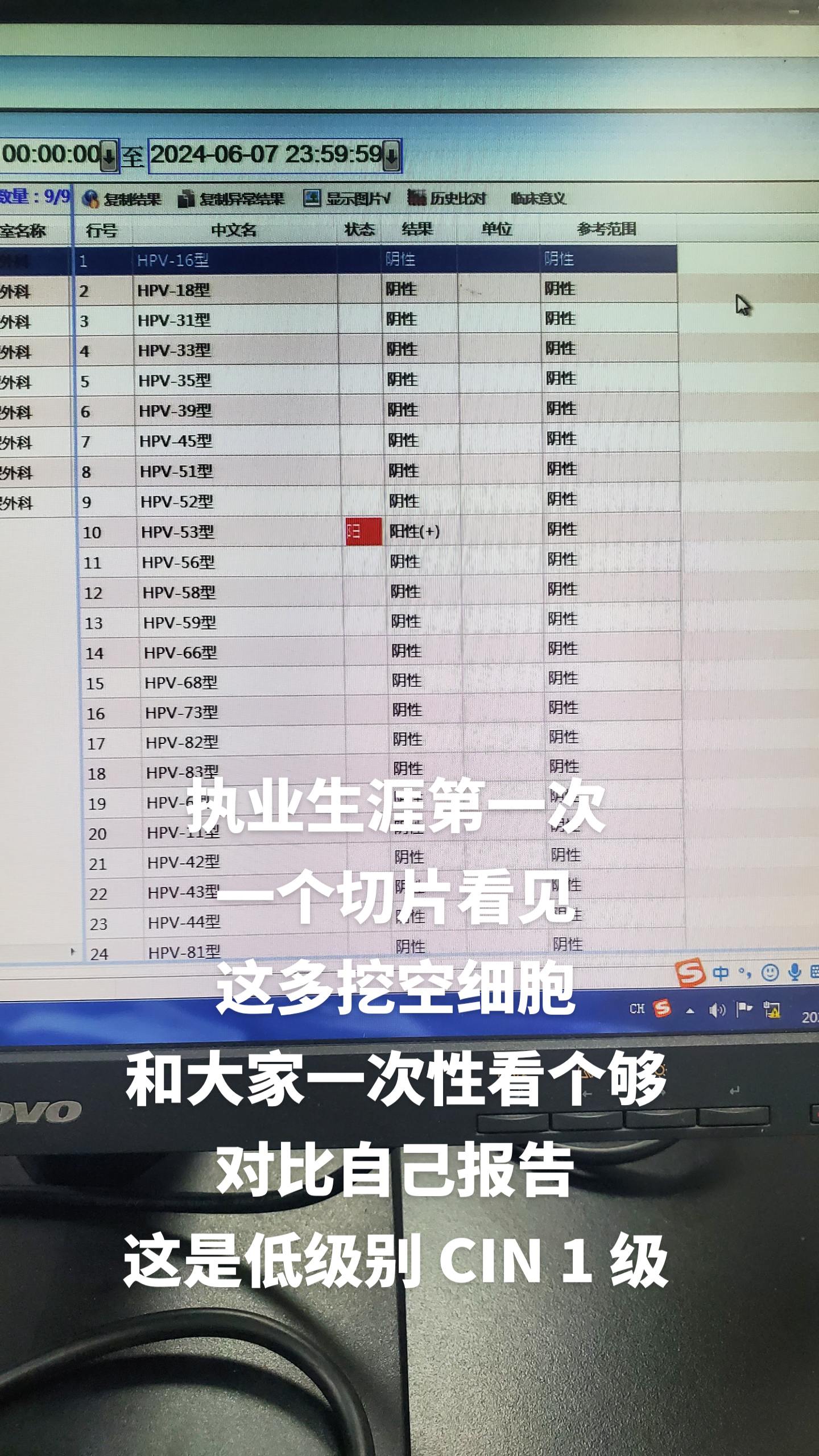 宫颈tct 
挖空细胞