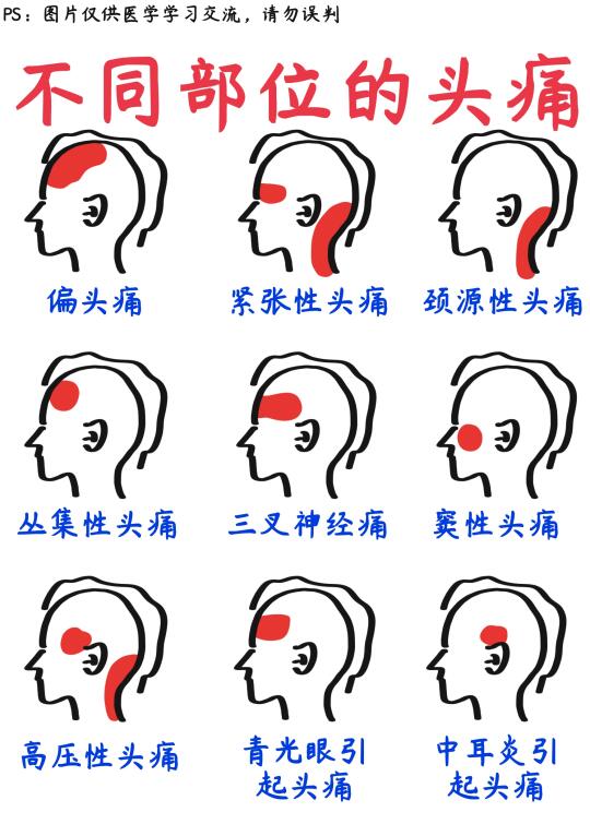 📒医学生笔记｜一文搞懂9种类型的头痛