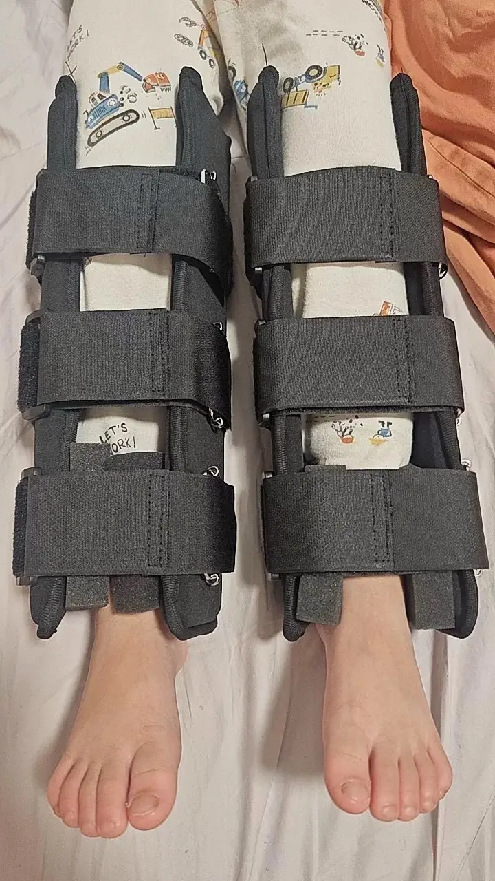 骨折康复训练 骨折康复之路 足内翻矫正记录 戴踝关节支具的正确方法 矫正腿型