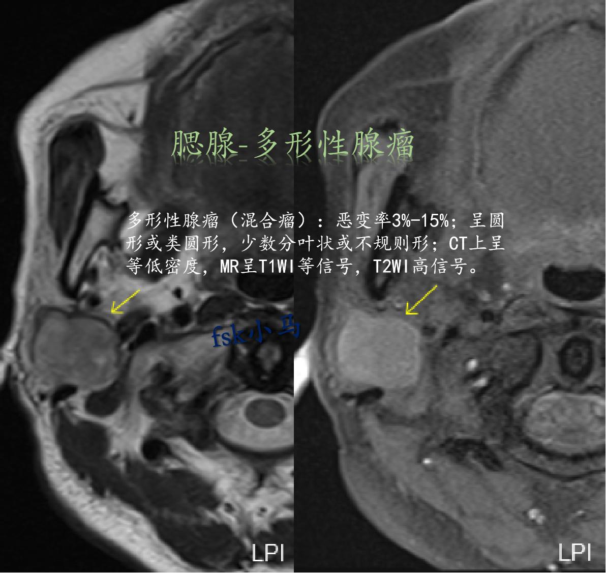 多形性腺瘤（混合瘤）：腮腺最常见的良性肿瘤，发病年龄较为广泛(平均年龄...