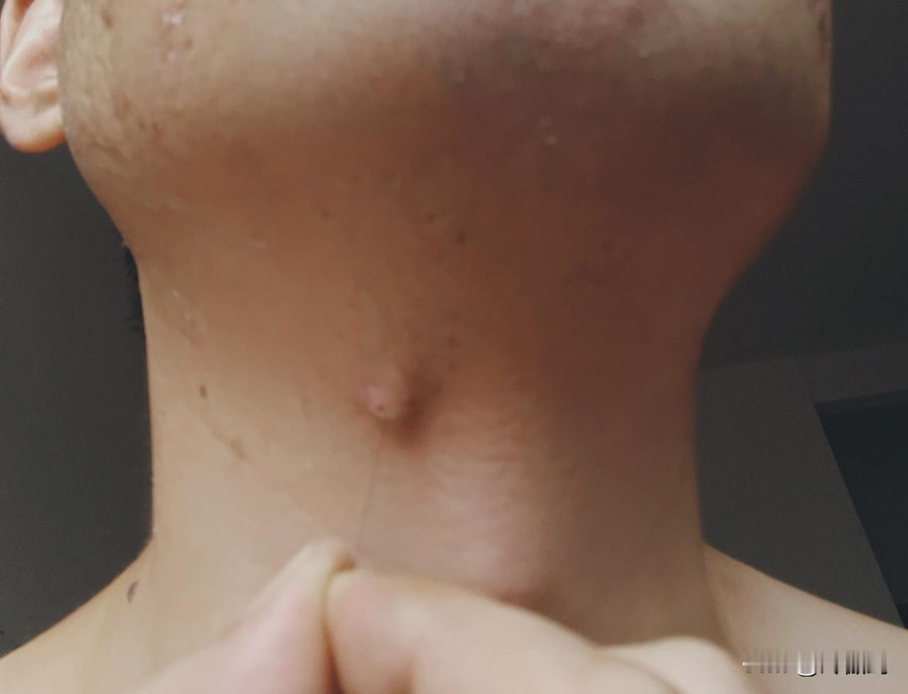 之前脖子上冒了个痘，之后反复发炎。某天，我瞧见痘痘上有个黑点，便拿粉刺针一挑，竟
