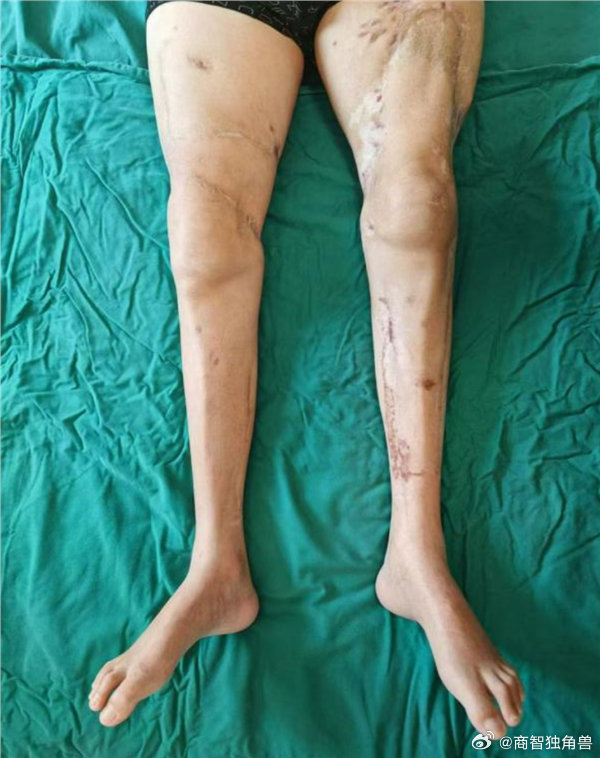 【我国完成全球首例双腿绞断再植手术】男子双腿绞断再植20个月后重新行走8月13日