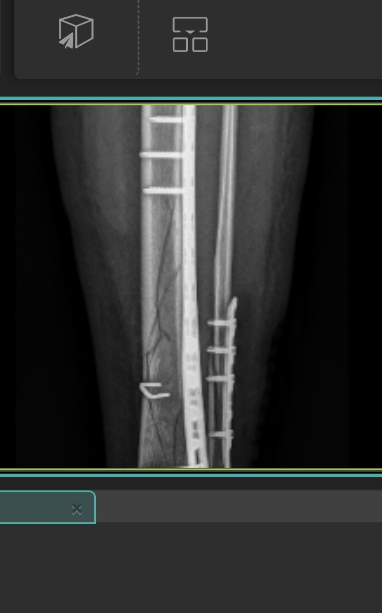 经过大夫的巧手已经修复了，剩下的就交给时间吧