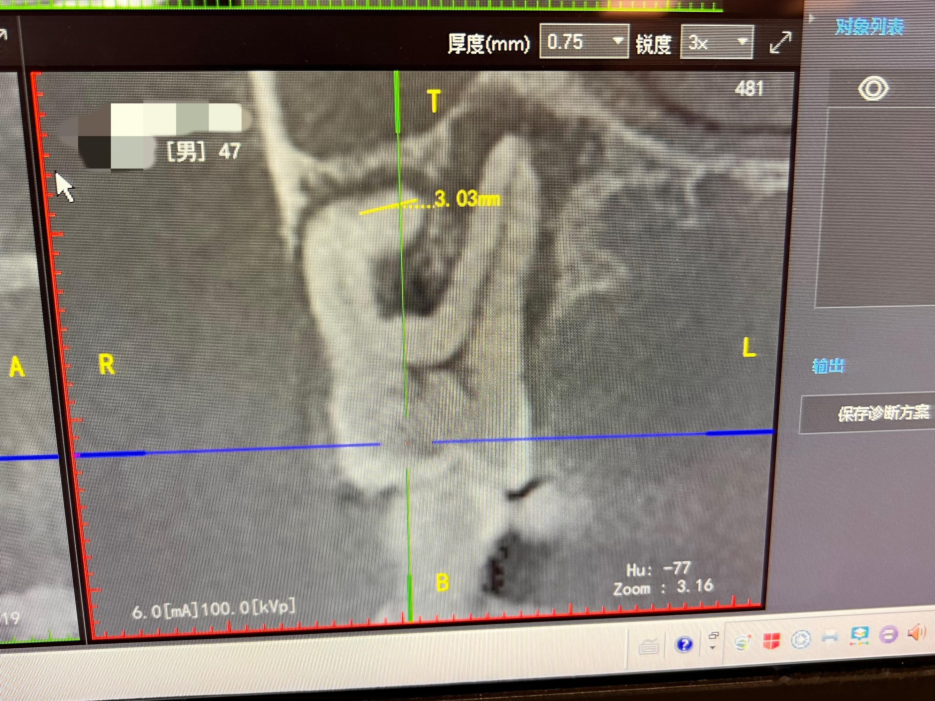 患者的牙华丽丽地跪了……（横向劈裂，拔了，我没跪，转出来了） 