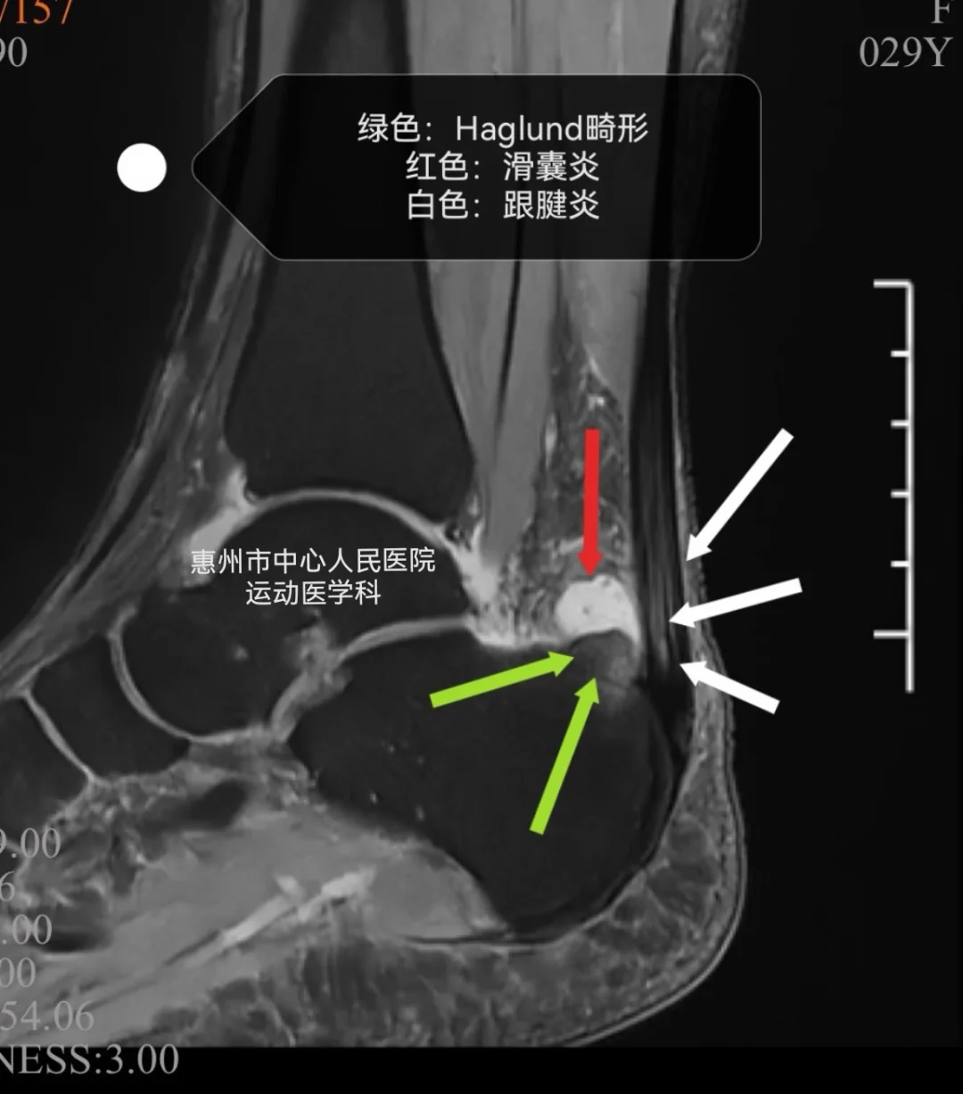 脚跟痛，会是什么问题呢？