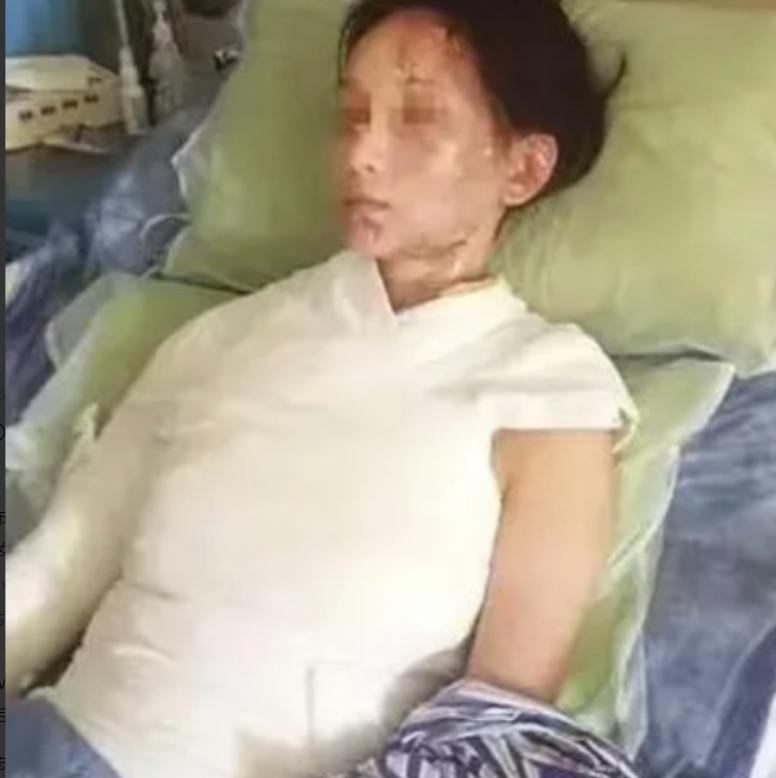 “这就是嘴欠的下场”！一盆滚烫高汤从头顶浇下，28岁温州姑娘林某的面容瞬间被高温
