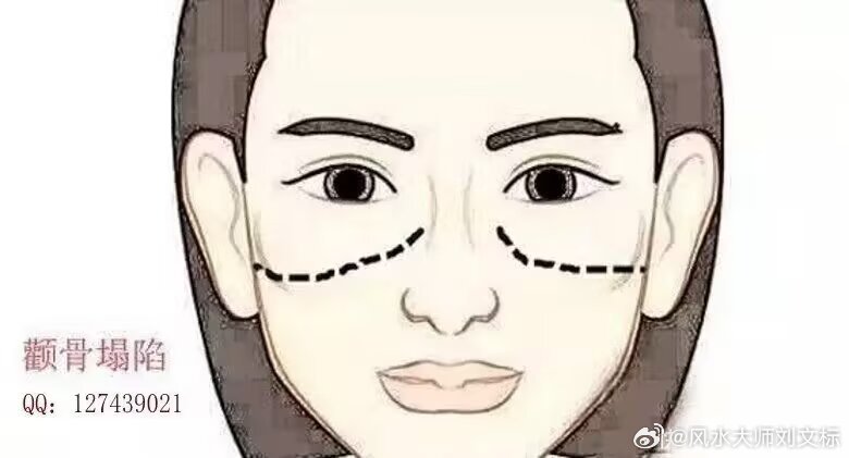 【颧骨塌陷】在工作事业中很难让众人服从，就是地位再高的人颧骨低也一样不会管教，再